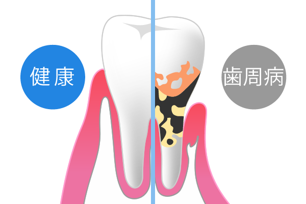 健康な歯と歯周病の歯
